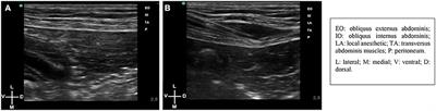 Analgesic efficacy of ultrasound-guided transversus abdominis plane block in dogs undergoing ovariectomy
